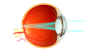 astigmatismo