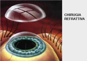 Chirurgia refrattiva