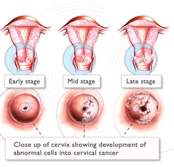 Cos e un papilloma virus, Cos e il papilloma virus sintomi