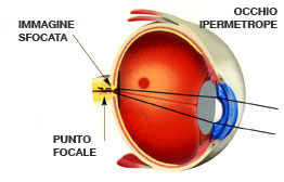 Ipermetropia