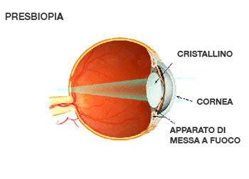 Presbiopia